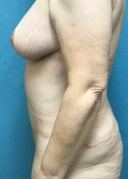Abdominoplasty #4387